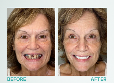 Snap-on Teeth Veneers